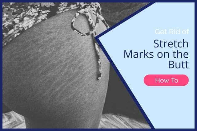 How To Get Rid Of Stretch Marks On The Butt 4933